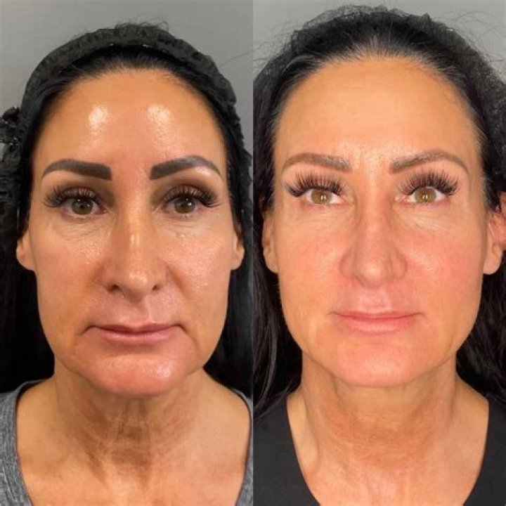 24 Before-And-After Photos From The Early Days of Plastic Surgery
