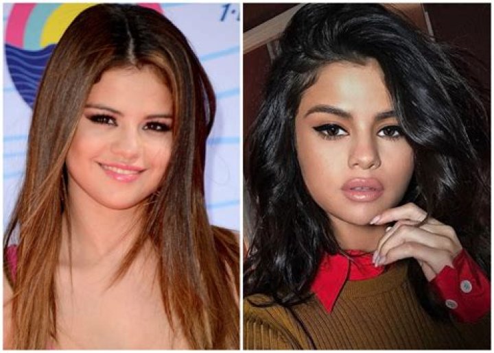 Did Selena Gomez Get Lip Injections? See the Pics!