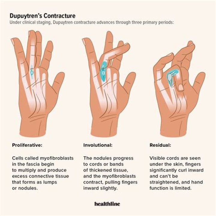 Does Bill Nighy have Dupuytren’s contracture?