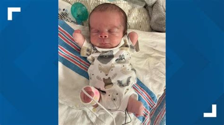 "He's Perfect the Way He Is"‘Miracle Baby’ Born Without a Nose is Absolutely Perfect