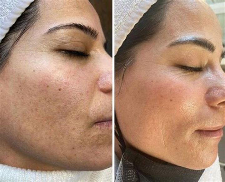 How to Reduce and Lighten Scars, According to Aesthetic Experts