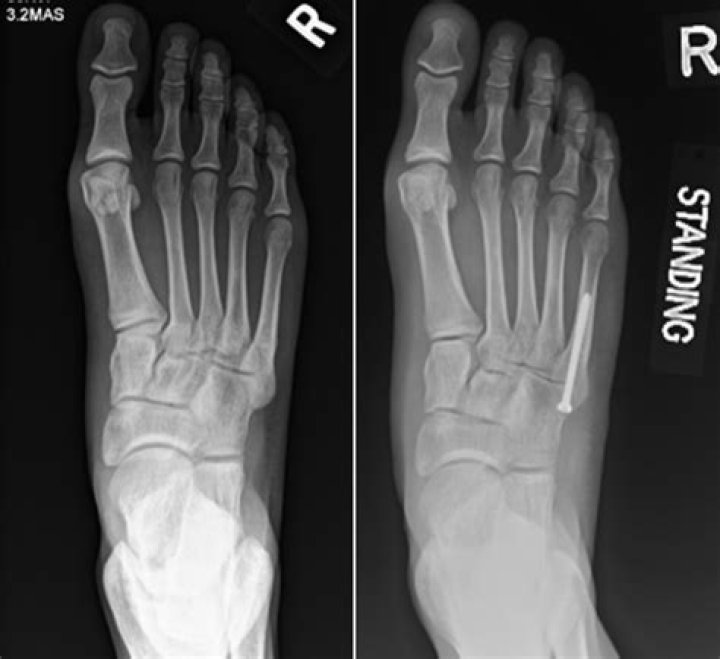 Kid Cudi Unveils Gruesome X-Ray Of Broken Foot After Surgery
