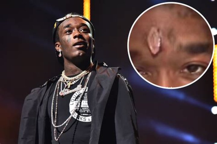 Lil Uzi Vert Says He Could Die From $24 Million Forehead Diamond