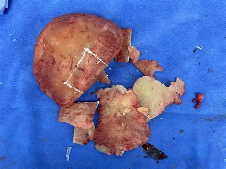 “Toxic Tush Doctor” Oneal Ron Morris Gets 10 Years in Prison For Cement Plastic Surgery!